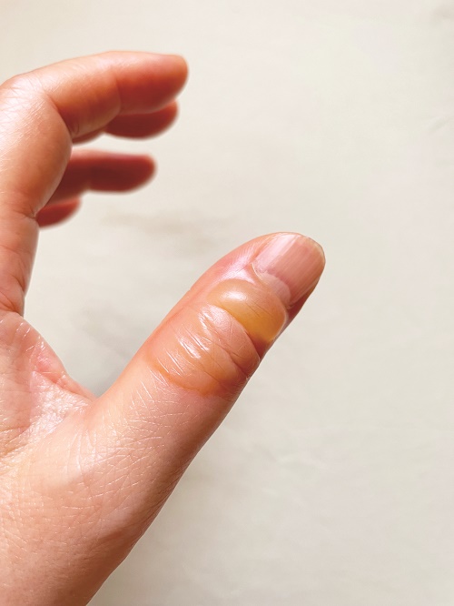 핫팩, 전기장판 저온화상 주의보